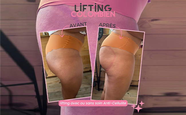 Lifting colombien avec massage dos ou l'anti-cellulite cuisse (1h)